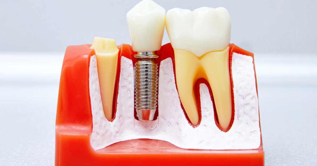 Maintaining Your Dental Implants