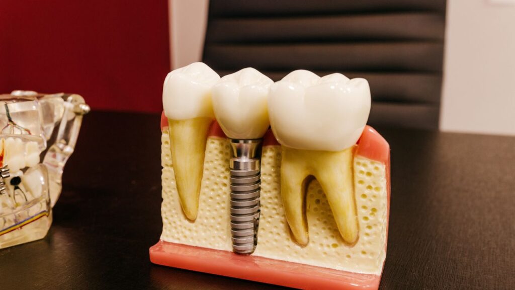 Importance of Dental Implants for Oral Health